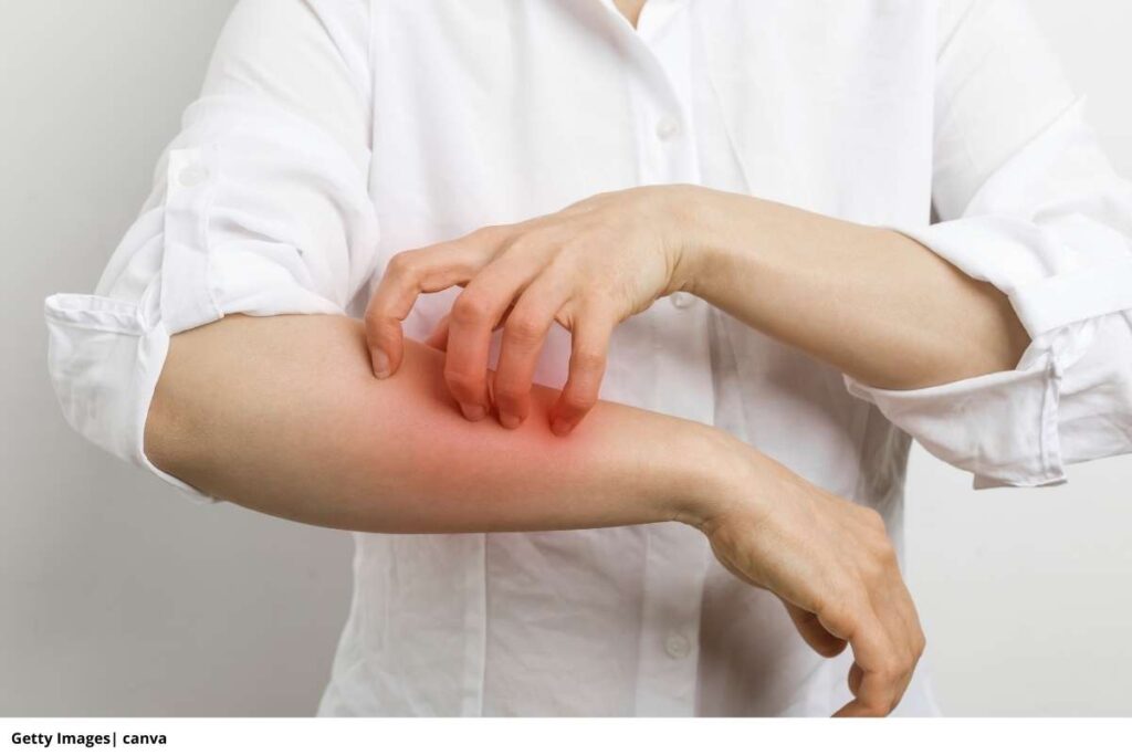 Imagen de una persona con síntomas de alergia